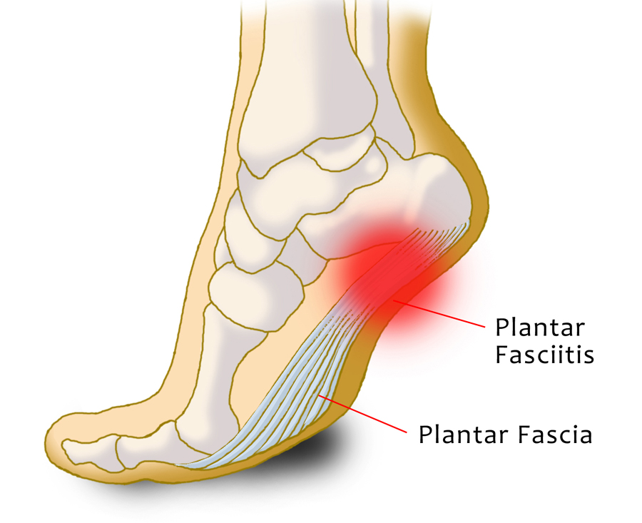 Heel pain clearance after standing