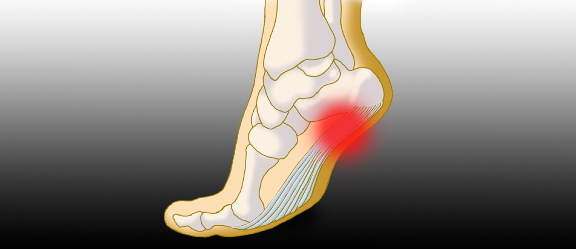 Heel pain from plantar on sale fasciitis